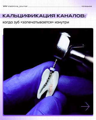 Кальцификация каналов: диагностика и лечение.